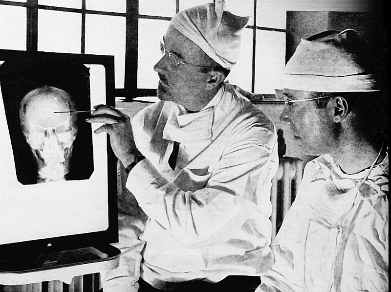 Learn What Lobotomy Is What Was Trying To Cure And Why Has Been